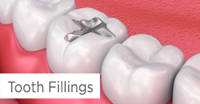 Tooth Fillings
