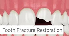 Tooth Fracture Restoration
