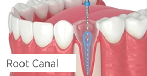 Root Canal