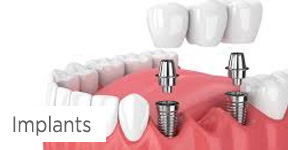 Implants