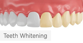 Teeth Whitening